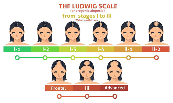 THE Ludwig scale for female hair loss - Watermans